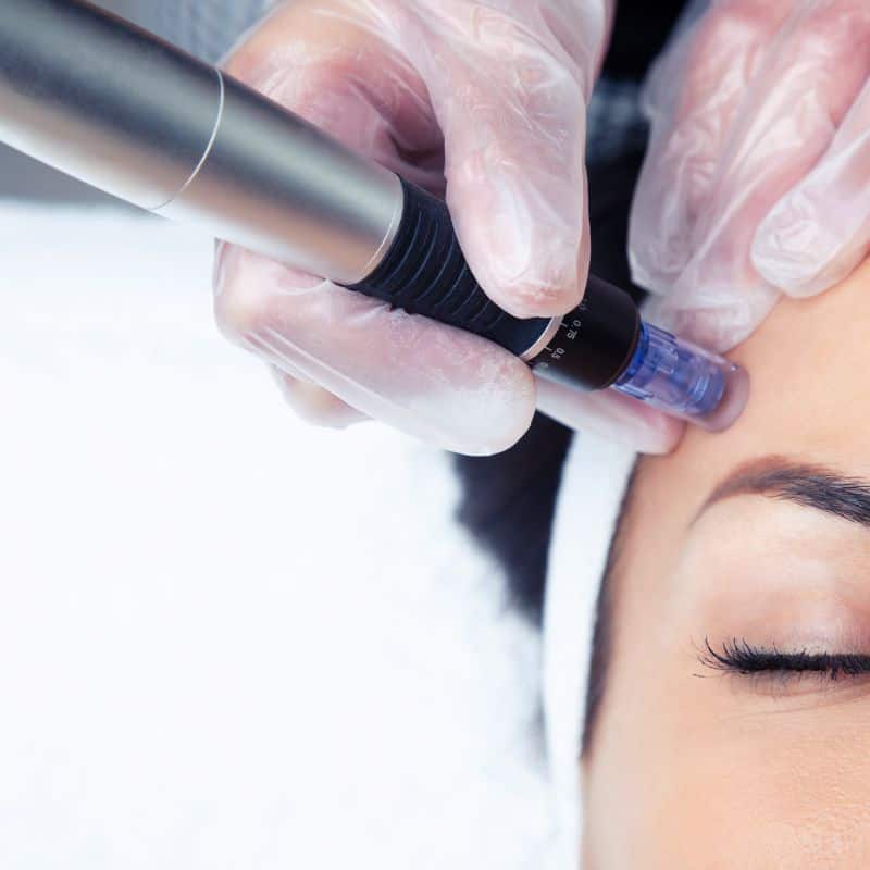 Morpheus8 treatment Theale from Lipo Sculpt - Book in today!